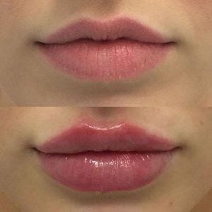 Schönheits-Sicherheits-Lippenvermehrungs-Füller-flüssiges Gel-kosmetische Lippeneinspritzungen
