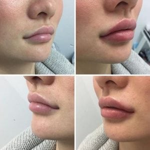 Prefilled Spritzen-Lippenvermehrungs-Füller-schnell Wiederaufnahme-erhebliche Auswirkung