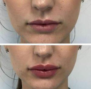 Schönheits-Sicherheits-Lippenvermehrungs-Füller-flüssiges Gel-kosmetische Lippeneinspritzungen