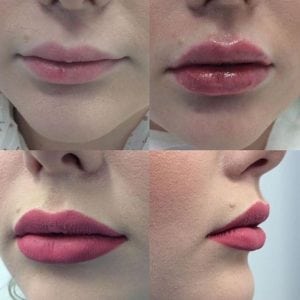 Prefilled Spritzen-Lippenvermehrungs-Füller-schnell Wiederaufnahme-erhebliche Auswirkung